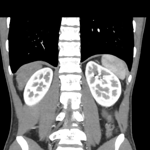File:Chronic calcific pancreatitis (Radiopaedia 56280-62953 E 27).jpg