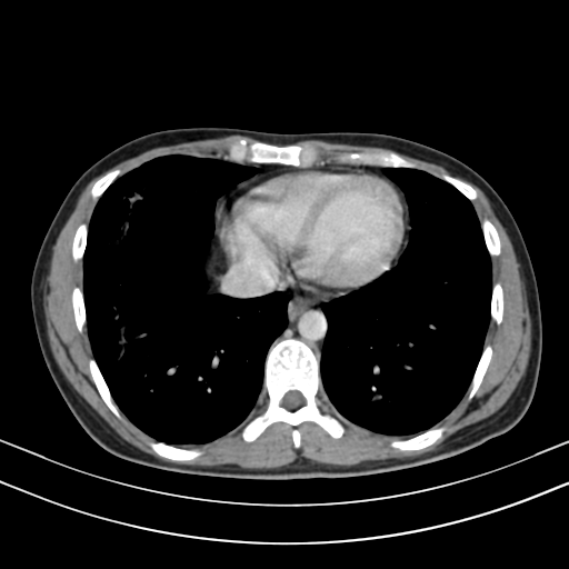 Chronic eosinophilic pneumonia (Radiopaedia 39331-41587 Axial C+ delayed 78).png