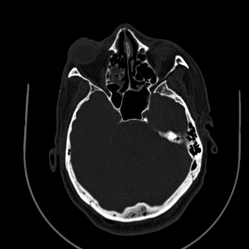 Chronic invasive fungal sinusitis (Radiopaedia 91563-109286 Axial sinus 67).jpg