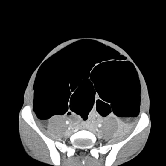 Chronic large bowel pseudo-obstruction (Radiopaedia 43181-46492 A 126).jpg