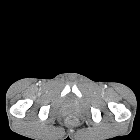 Chronic large bowel pseudo-obstruction (Radiopaedia 43181-46492 A 164).jpg