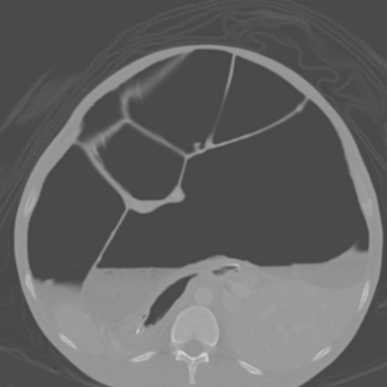File:Chronic large bowel pseudo-obstruction (Radiopaedia 43181-46492 Axial bone window 70).jpg