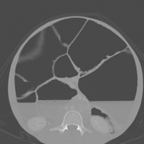 Chronic large bowel pseudo-obstruction (Radiopaedia 43181-46492 Axial bone window 98).jpg