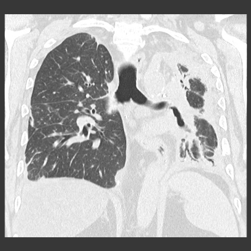 File:Chronic lung allograft dysfunction - restrictive form (Radiopaedia 60595-68316 Coronal lung window 65).jpg