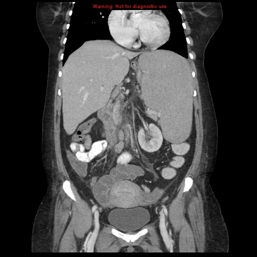 File:Chronic myeloid leukemia with splenic infarction (Radiopaedia 9178-9874 E 30).jpg