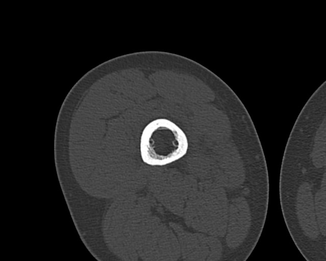 File:Chronic ostemyelitis of the femur with long sinus tract (Radiopaedia 74947-85982 Axial bone window 104).jpg
