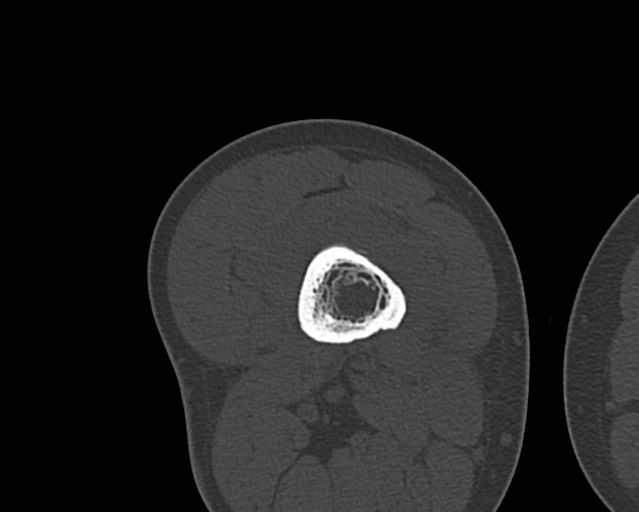 Chronic ostemyelitis of the femur with long sinus tract (Radiopaedia 74947-85982 Axial bone window 130).jpg