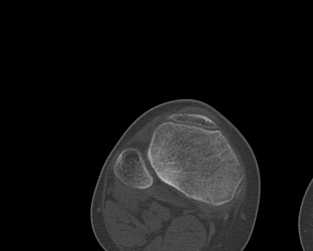 File:Chronic ostemyelitis of the femur with long sinus tract (Radiopaedia 74947-85982 Axial bone window 242).jpg