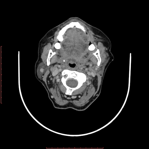 File:Chronic osteomyelitis - maxilla (Radiopaedia 23783-23927 B 48).jpg
