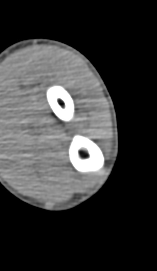 Chronic osteomyelitis of the distal humerus (Radiopaedia 78351-90971 Axial non-contrast 119).jpg