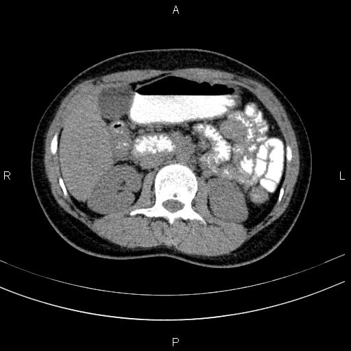 Chronic pancreatitis (Radiopaedia 64576-73450 Axial non-contrast 64).jpg