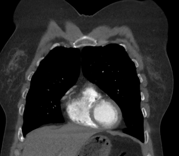 Chronic pulmonary embolus (Radiopaedia 39129-41341 Coronal C+ CTPA 25).png