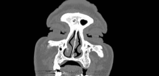 File:Chronic sphenoidal sinusitis (Radiopaedia 62030-70122 Coronal bone window 16).jpg