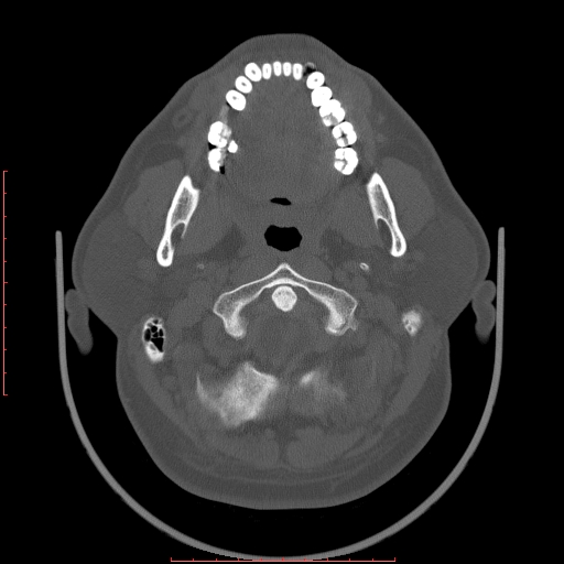 Chronic submandibular sialolithiasis (Radiopaedia 69817-79814 Axial bone window 25).jpg