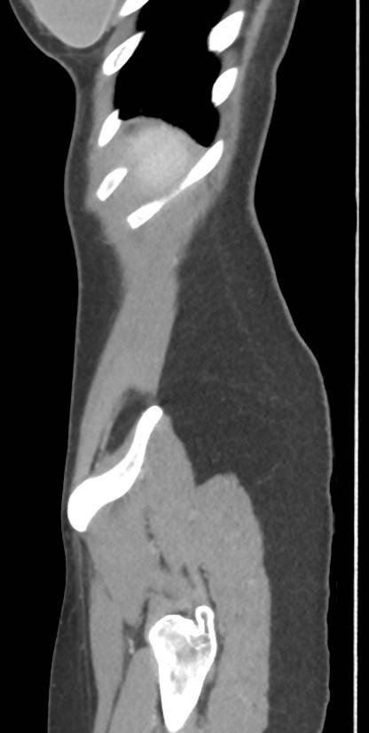Circumaortic left renal vein with a duplicated retroaortic vein (Radiopaedia 91668-109398 C 117).jpg