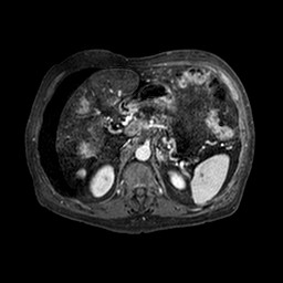 Cirrhosis and hepatocellular carcinoma in the setting of hemochromatosis (Radiopaedia 75394-86594 Axial T1 C+ fat sat 212).jpg