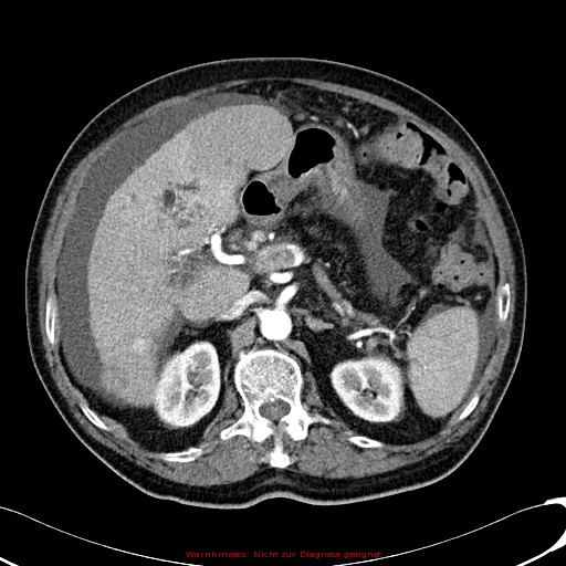 File:Cirrhosis and hepatocellular carcinoma in the setting of hemochromatosis (Radiopaedia 75394-86595 A 33).jpg