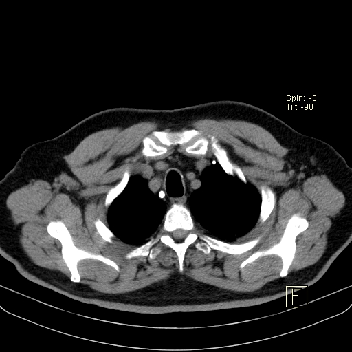 File:Classic complicated silicosis (Radiopaedia 49720-54961 Axial liver window 7).jpg