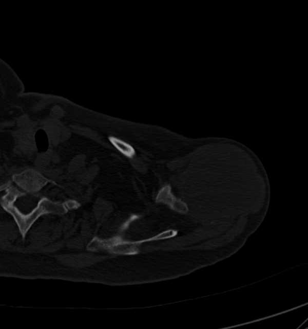 Clear cell chondrosarcoma - humerus (Radiopaedia 63104-71612 Axial bone window 21).jpg