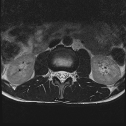 File:Clear cell meningoma - lumbar spine (Radiopaedia 60116-67690 Axial T2 33).png