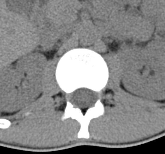 File:Clear cell meningoma - lumbar spine (Radiopaedia 60116-67691 Axial non-contrast 11).png