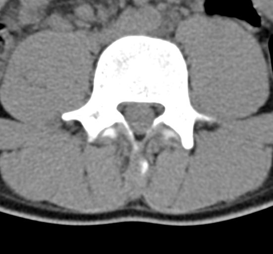 Clear cell meningoma - lumbar spine (Radiopaedia 60116-67691 Axial non-contrast 48).png