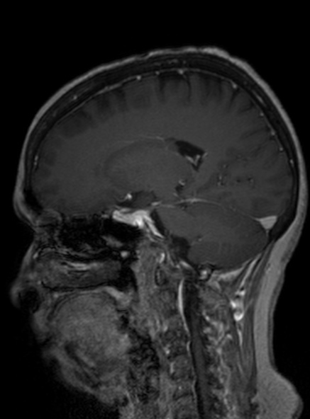 Clival meningioma (Radiopaedia 53278-59248 Sagittal T1 C+ 230).jpg