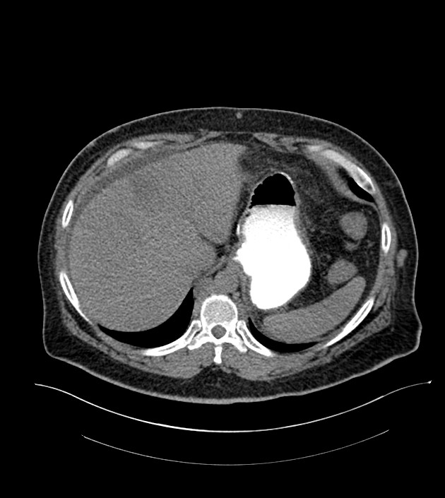 Closed-loop small bowel obstruction-internal hernia (Radiopaedia 78439-91096 Axial non-contrast 29).jpg