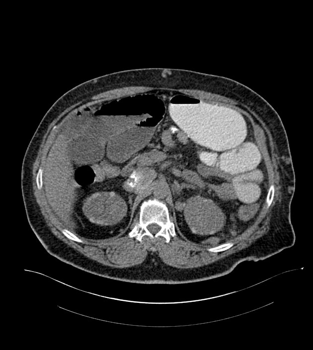 Closed-loop small bowel obstruction-internal hernia (Radiopaedia 78439-91096 Axial non-contrast 51).jpg