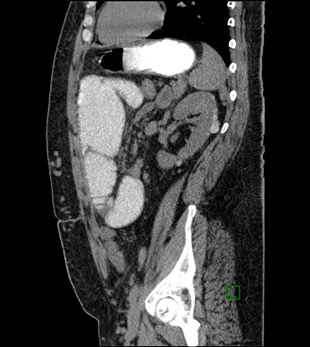 Closed-loop small bowel obstruction-internal hernia (Radiopaedia 78439-91096 C 53).jpg