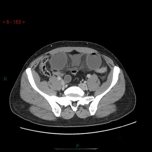 Closed loop obstruction and appendicular stump mucocele (Radiopaedia 54014-60163 A 90).jpg