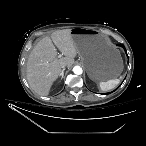 File:Closed loop obstruction due to adhesive band, resulting in small bowel ischemia and resection (Radiopaedia 83835-99023 B 35).jpg