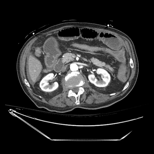Closed loop obstruction due to adhesive band, resulting in small bowel ischemia and resection (Radiopaedia 83835-99023 B 59).jpg