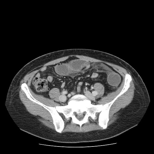 File:Closed loop small bowel obstruction (Radiopaedia 65403-74451 A 57).jpg