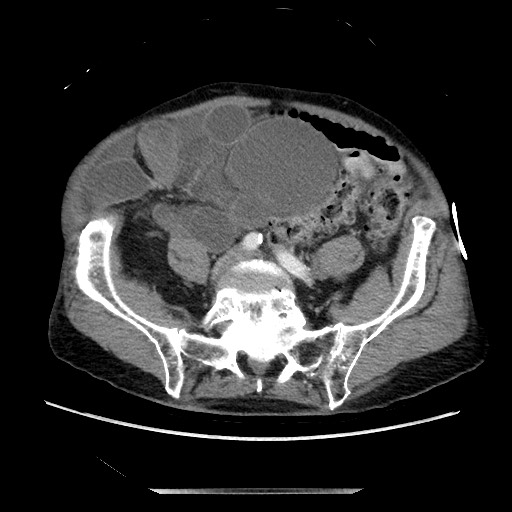File:Closed loop small bowel obstruction - adhesive disease and hemorrhagic ischemia (Radiopaedia 86831-102990 A 131).jpg