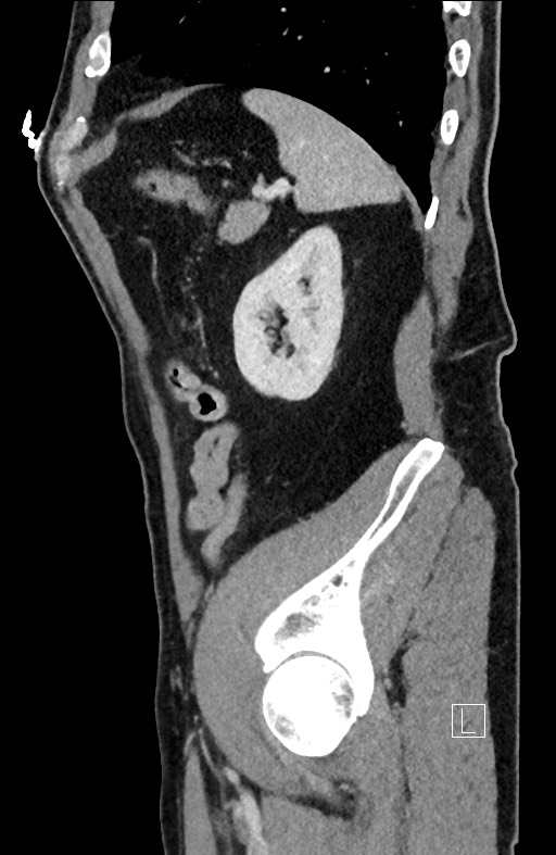 Closed loop small bowel obstruction - internal hernia (Radiopaedia 57806-64778 C 28).jpg