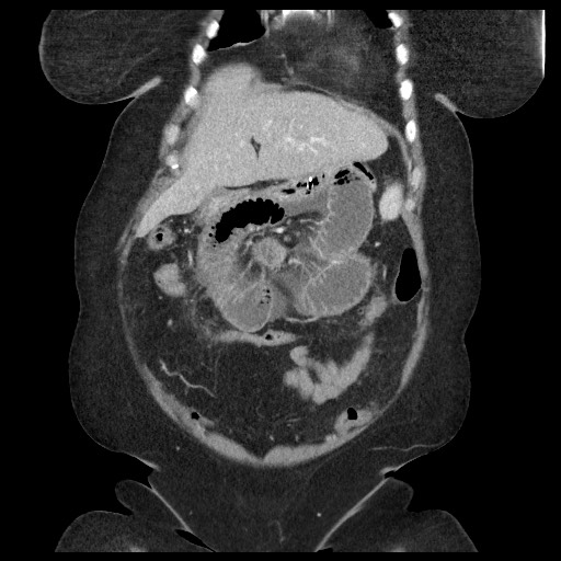 Closed loop small bowel obstruction - internal hernia (Radiopaedia 65402-74450 B 29).jpg