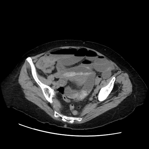 Closed loop small bowel obstruction due to adhesive band, with intramural hemorrhage and ischemia (Radiopaedia 83831-99017 Axial non-contrast 127).jpg
