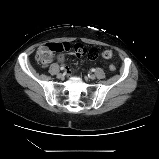 Closed loop small bowel obstruction due to adhesive bands - early and late images (Radiopaedia 83830-99014 A 111).jpg