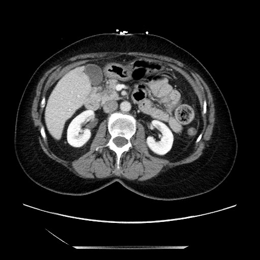File:Closed loop small bowel obstruction due to adhesive bands - early and late images (Radiopaedia 83830-99014 A 55).jpg