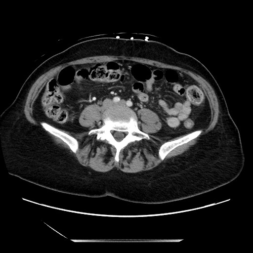 Closed loop small bowel obstruction due to adhesive bands - early and late images (Radiopaedia 83830-99014 A 92).jpg