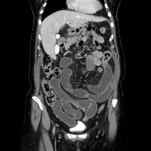 Closed loop small bowel obstruction due to adhesive bands - early and late images (Radiopaedia 83830-99015 B 43).jpg