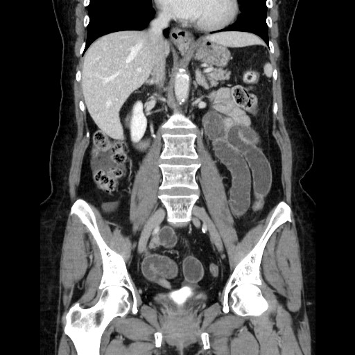 File:Closed loop small bowel obstruction due to adhesive bands - early and late images (Radiopaedia 83830-99015 B 69).jpg