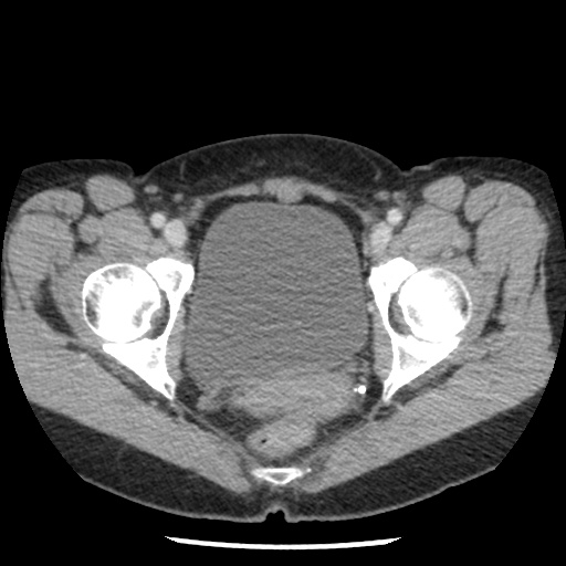 File:Closed loop small bowel obstruction due to trans-omental herniation (Radiopaedia 35593-37109 A 81).jpg