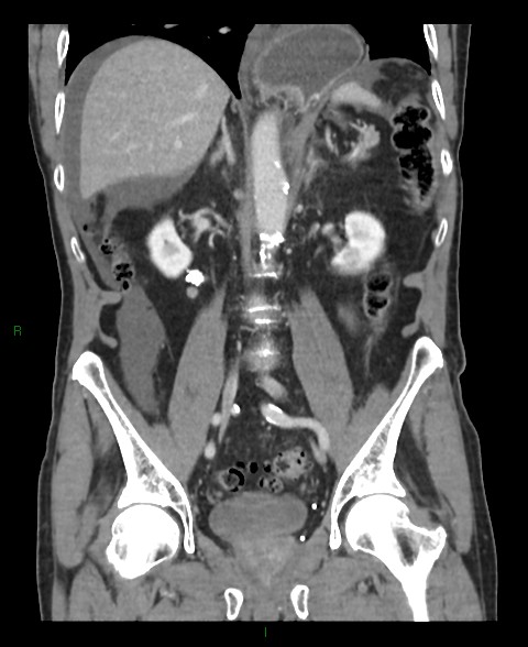 Closed loop small bowel obstruction with ischemia (Radiopaedia 84180-99456 B 29).jpg