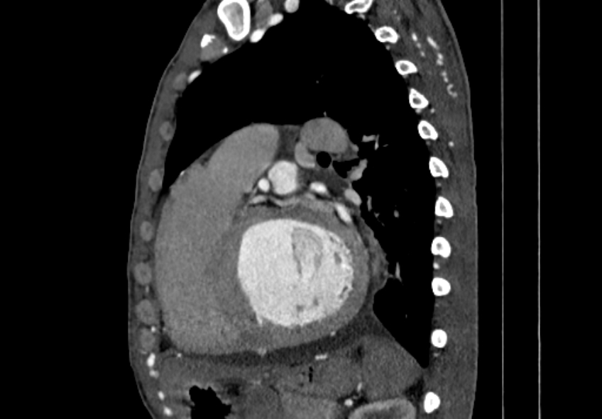Coarctation of aorta with aortic valve stenosis (Radiopaedia 70463-80574 B 111).jpg