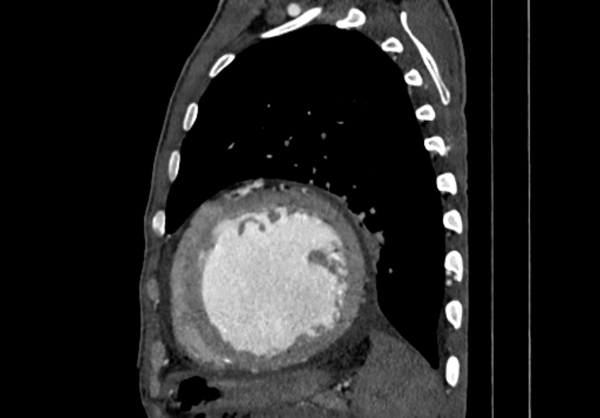 Coarctation of aorta with aortic valve stenosis (Radiopaedia 70463-80574 B 159).jpg