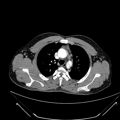 File:Coarctation of the aorta (Radiopaedia 49784-55050 B 59).jpg
