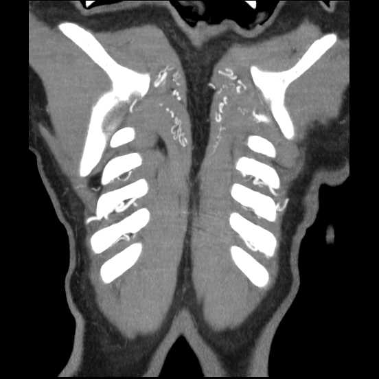 Coarctation of the aorta (Radiopaedia 67609-77010 B 5).jpg