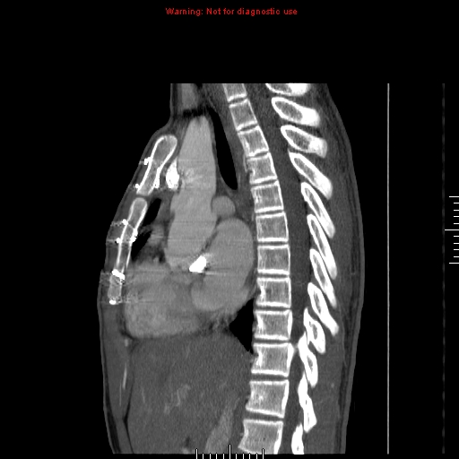 File:Coarctation of the aorta (Radiopaedia 9434-10118 B 26).jpg